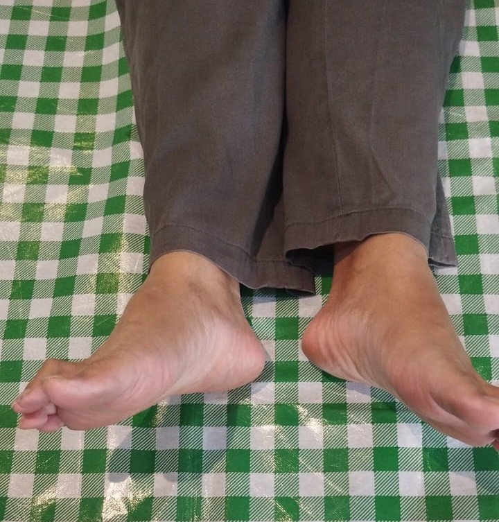 Patah Tulang